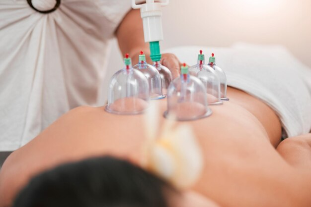 Acupuncture therapist using cupping therapy on female patient's back.